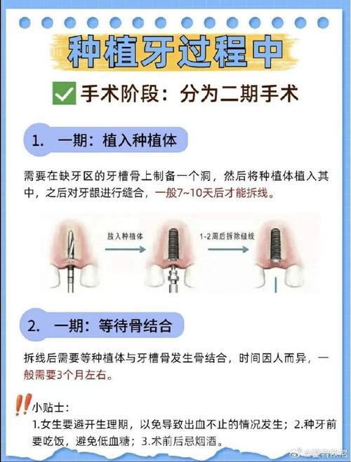 植牙手术中文版流程，简单易懂的种牙指南！