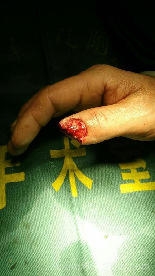 看见清创恶心图片后，我再也不敢忽视小伤口了！