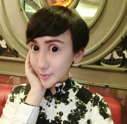 微整失败不吸收图片_微整形 玻尿酸注射风险 _ 玻尿酸交联后遗症 